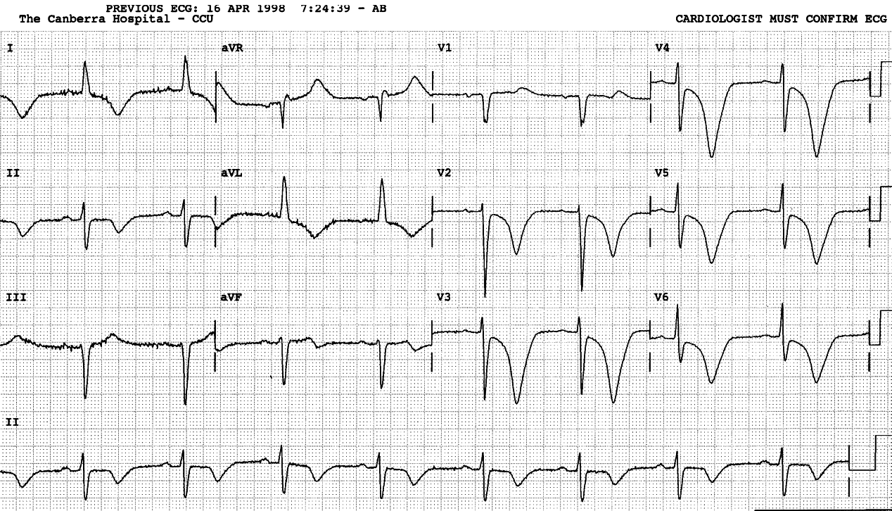 78 year old lady with unstable angina