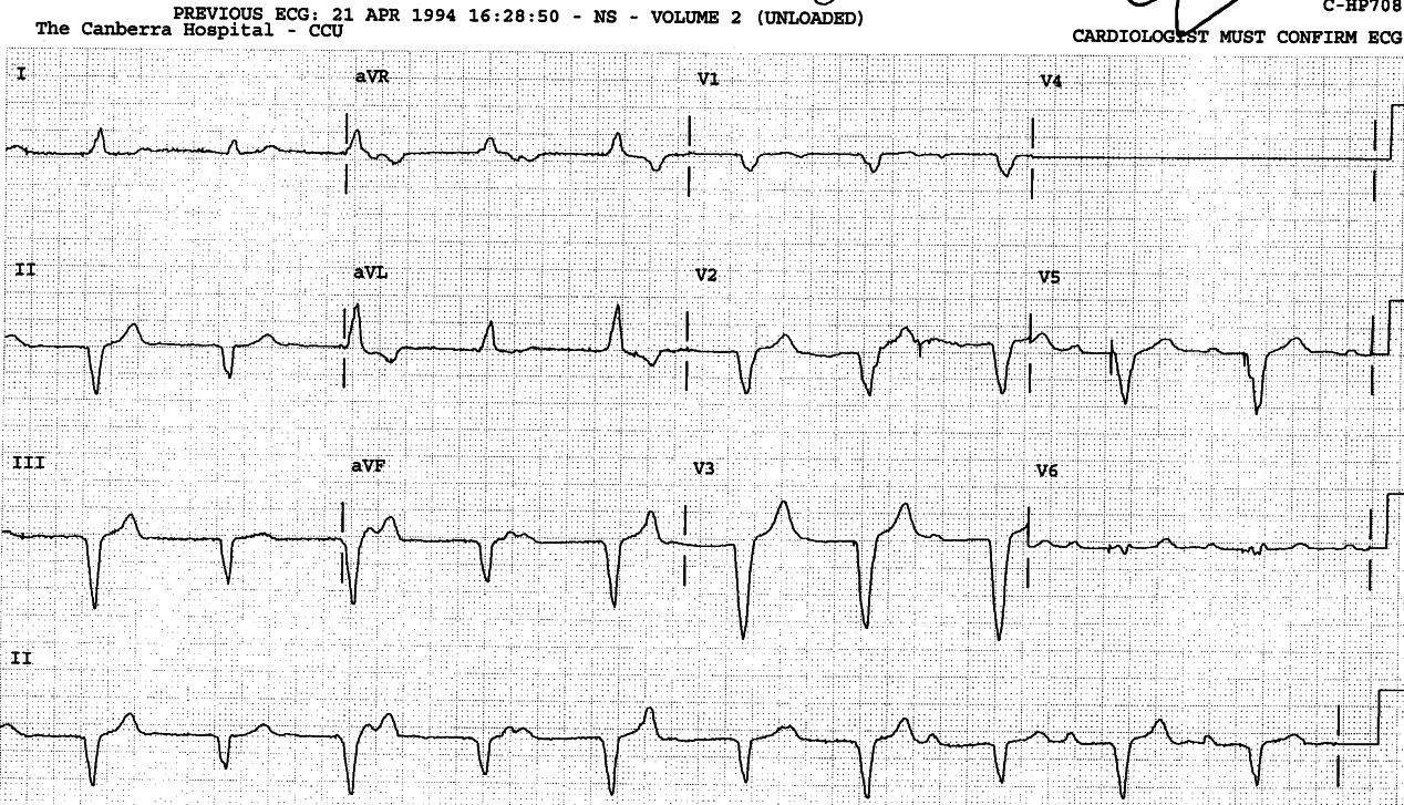 The same patient as on the preceding page, admitted to CCU and
fitted with a temporary pacemaker.