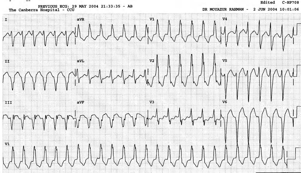 CCU recording of a 63 year old man with history of remote myocardial infarction. He is aware of tachycardia but is otherwise asymptomatic. 