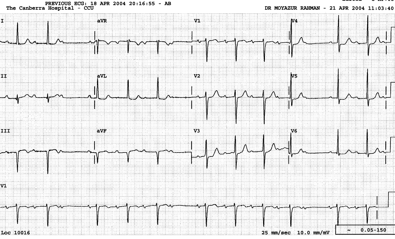 74 year old man one week after acute inferior infarction. 