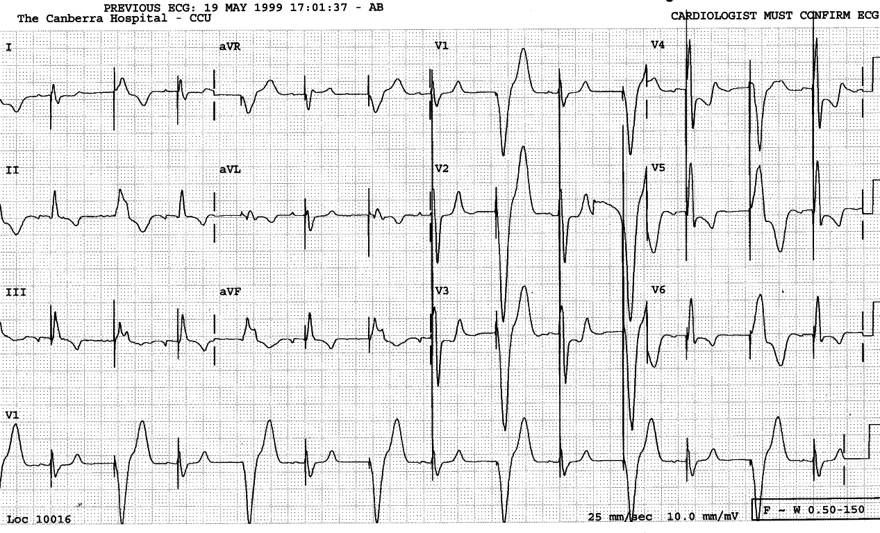 Imperceptible bigeminy and obvious alternation in an 82 year old
man with congestive cardiac failure and angina.