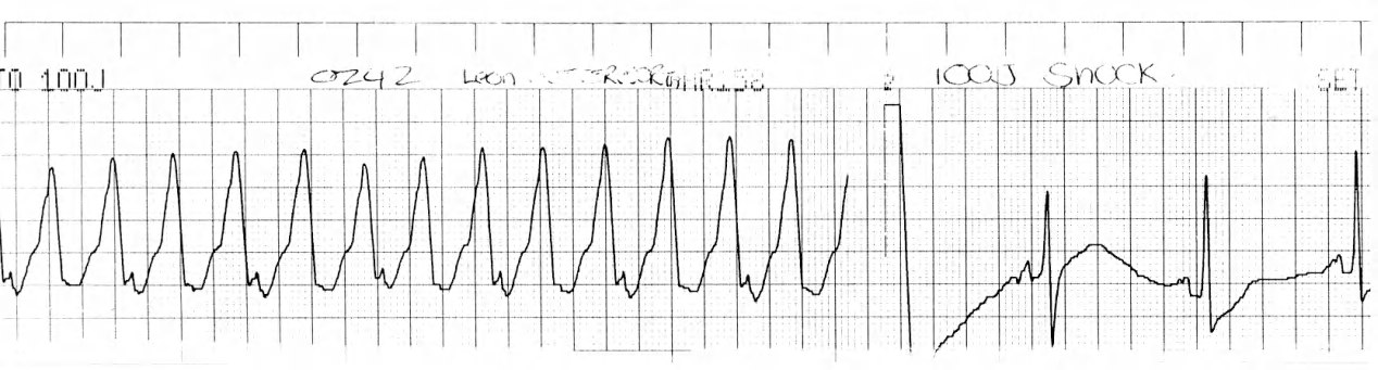 Retrograde 2:1 VA block. I almost delayed the shock to see more of it. 