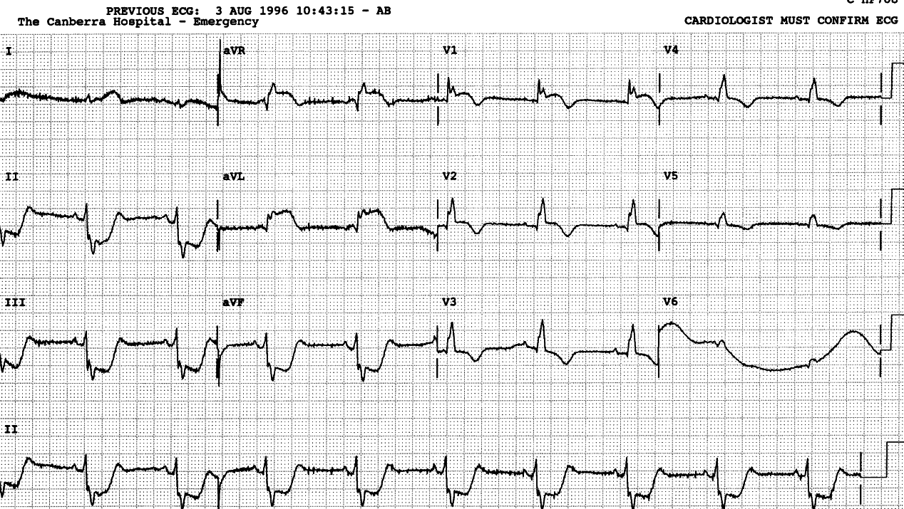 Sinus rhythm.