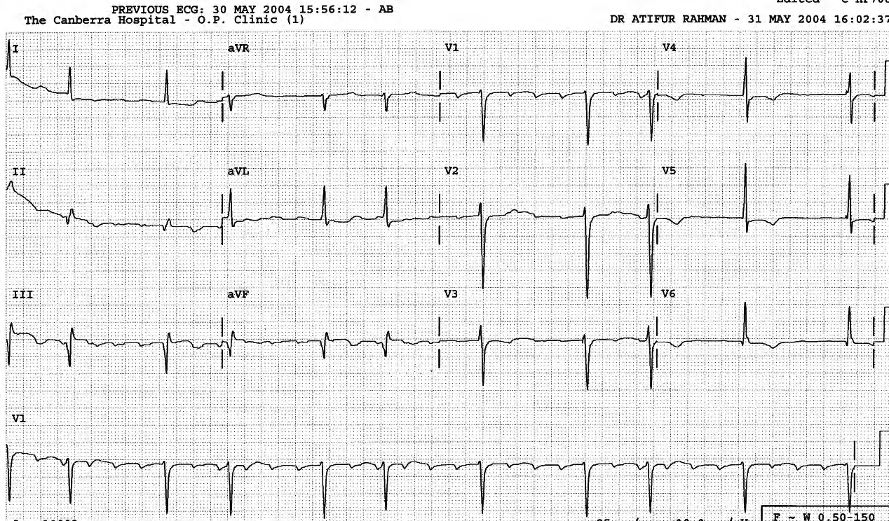 In conducted flutter, the corresponding F-R interval are identical throughout. 