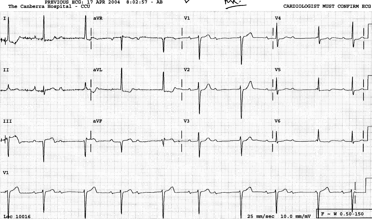 Classic escape-capture bigeminy. Junctional escapes are very similar to conducted sinus beats, but slightly larger or smaller in most leads. 