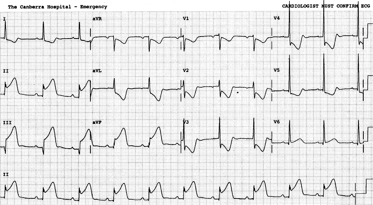 66 year old lady in Casualty with chest pain.