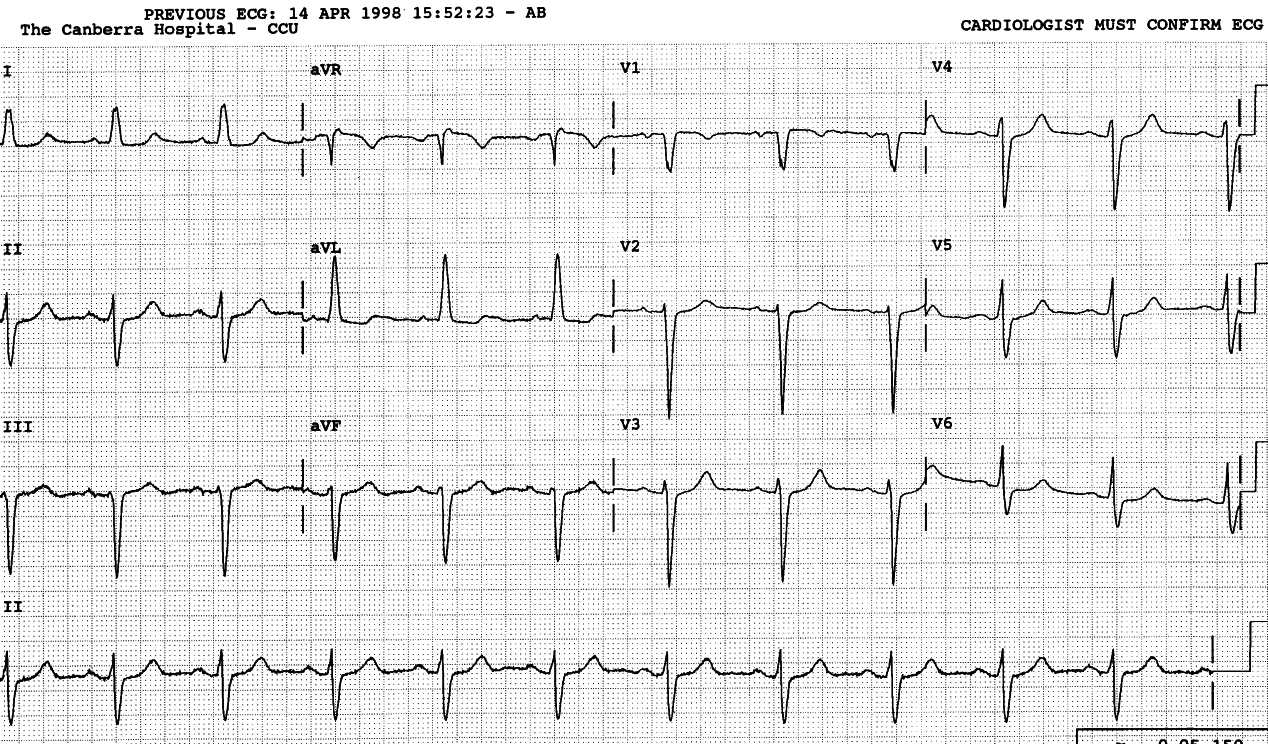 T wave is the most labile part of the cardiogram.