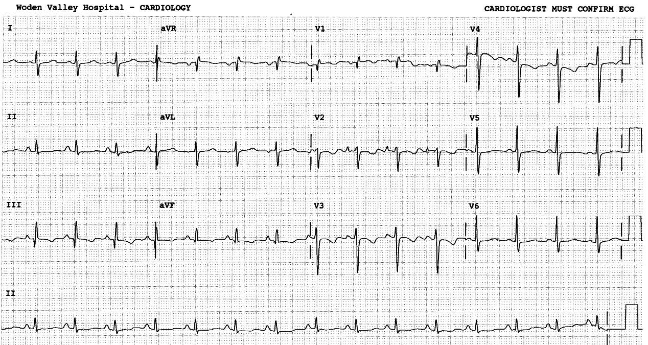 47 year old man with history of DVT, admitted with marked shortness of breath, cyanosis and clear CXR