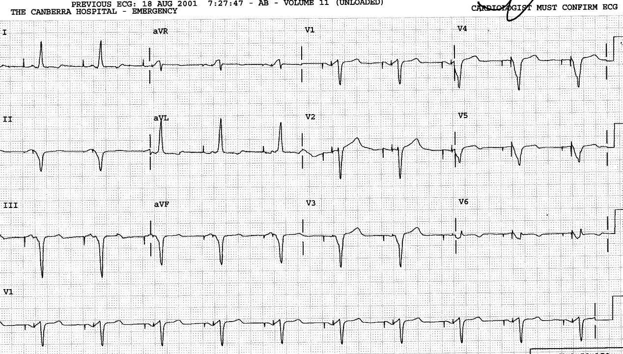 59 year old man with ischaemic cardiomyopathy paced
by an ICD.