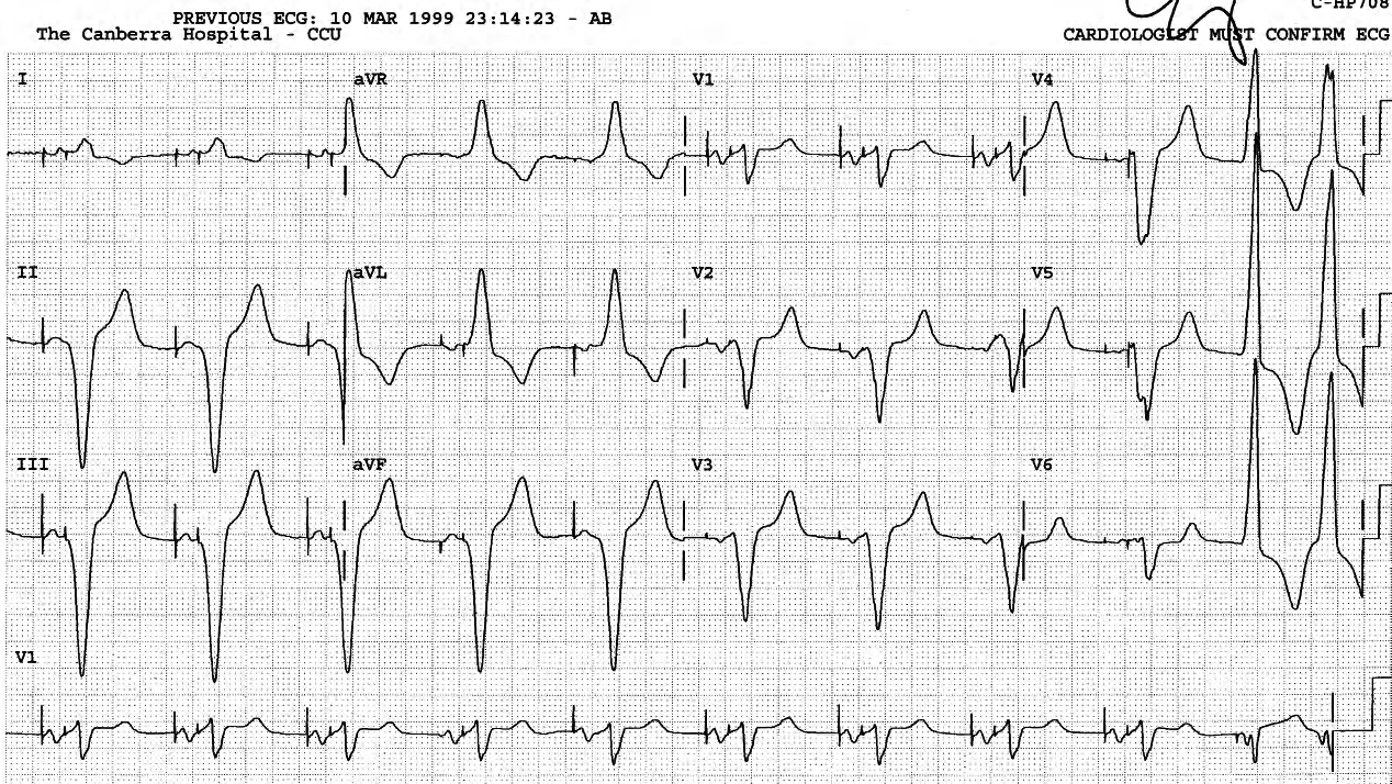 AV-paced rhythm with a VEB couplet. 