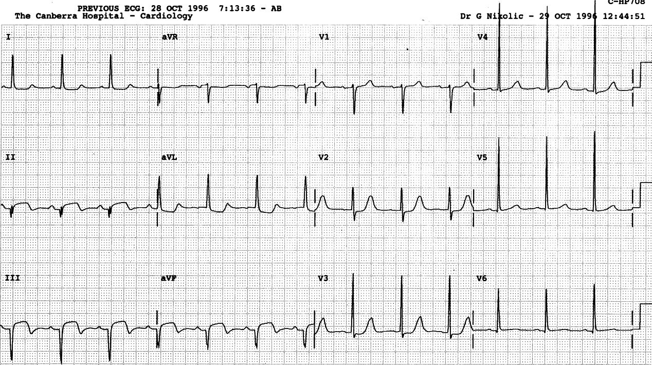 Stage of inferior MI, four days from oset. Lead V6 participates, but only by way of its flattened T wave; this is best ignored in routine reporting.