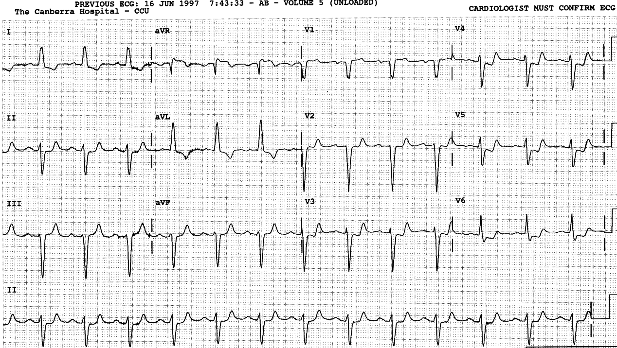 Recurrence of angina