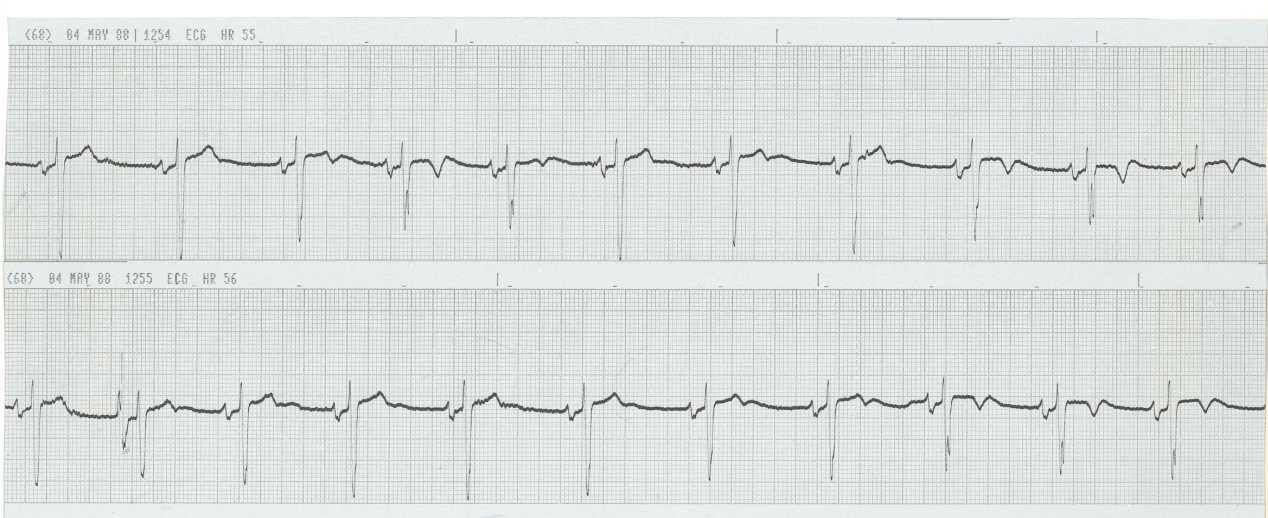 56 year old woman with chronic angina pectoris. What is the significance of her repolarisation changes?