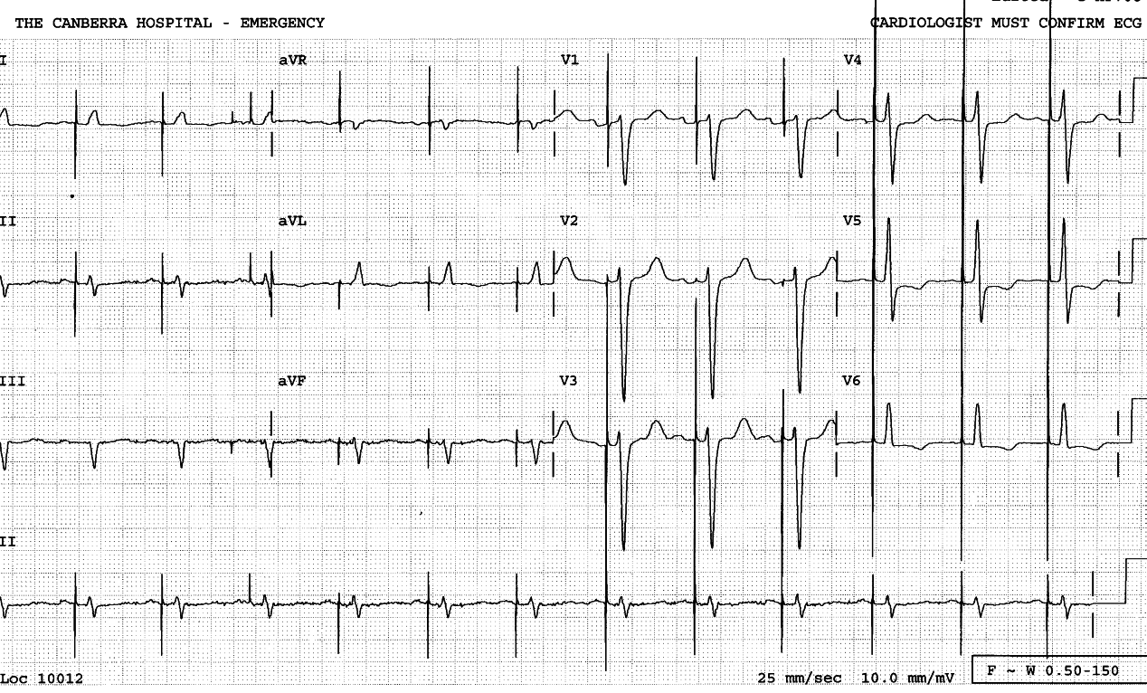 Asymptomatic 49 year old dialysis patient with
permanent DDD pacemaker.