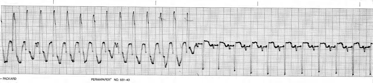 63 year old man with old inferior infarct and recurrent tachycardia, presenting virtually incontrovertible evidence that itâs ventricular. 