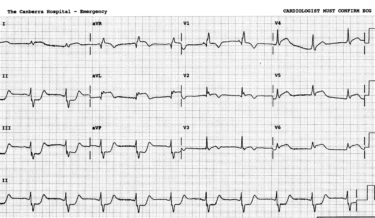 68 year old man with chest pain, shock and (entirely justified) feeling of doom.