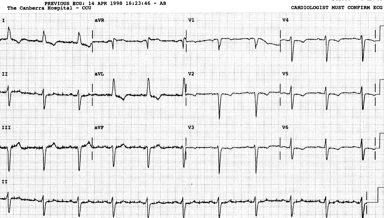 Resolution of angina. T waves are inverting again.