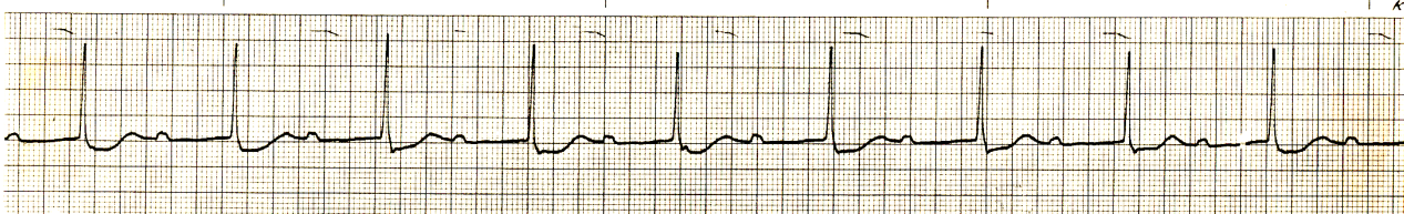 The Bix Rule illustrated in a 55 year old woman with inferior     infarction and LVH. If one knows what it is it is easy to see how it is     illustrated. 