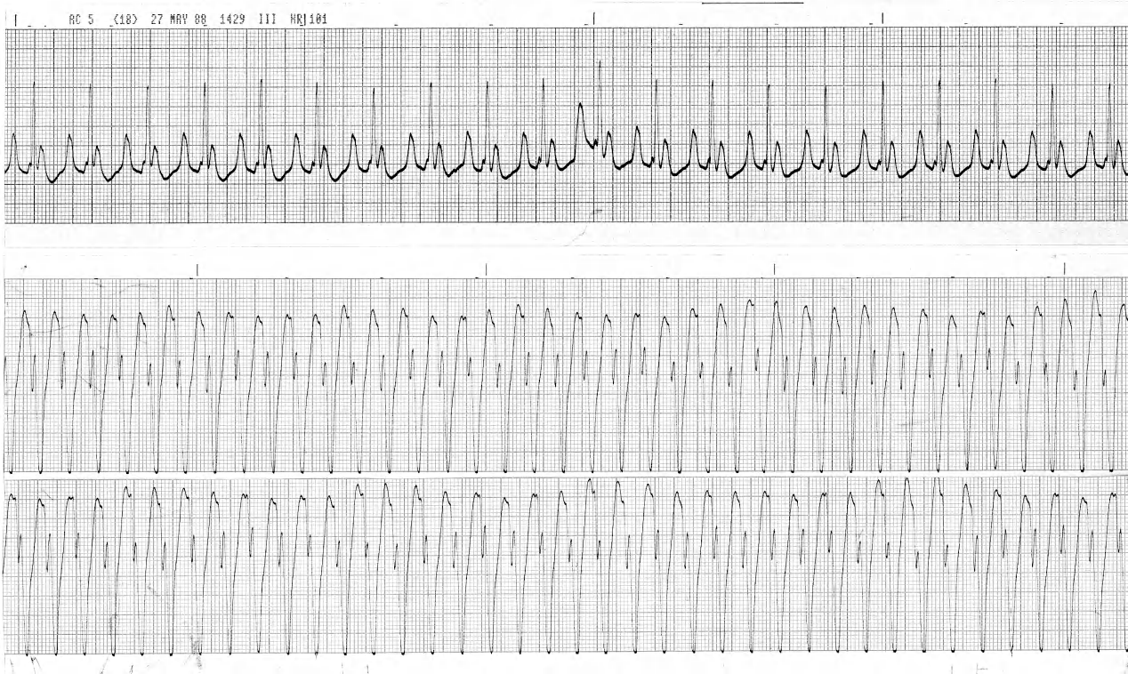 34 year old man one day after quinidine (mono)therapy was started. He had recurrent arrhythmias since aortic valve replacement a year previously. 