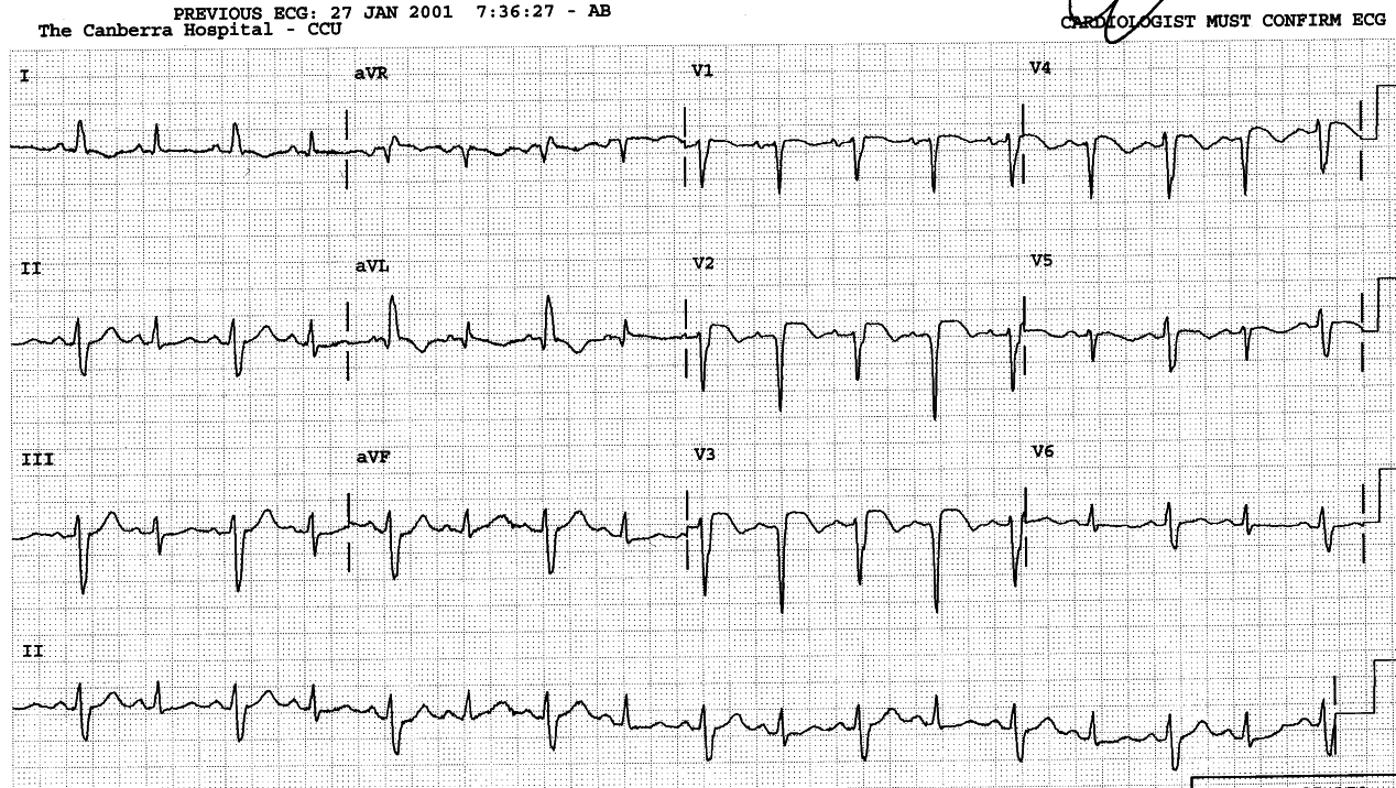 68 year old lady with dyspnÅa, nausea and sweating.