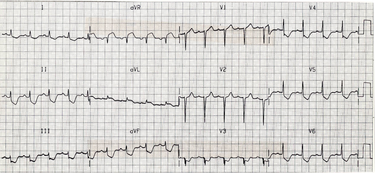 81 year old lady in fatal cardiogenic shock.