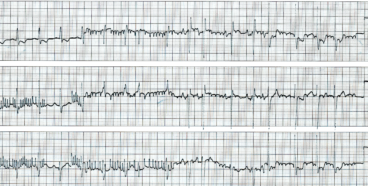 73 year old woman recently cardioverted by DC shock from atrial flutter, despite toxic digoxin level