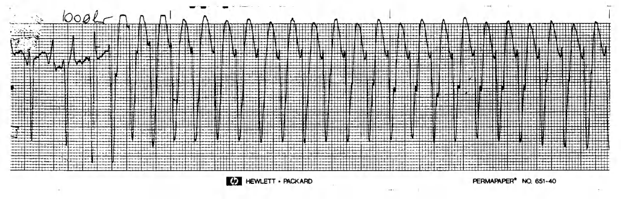 Atrial rate is the same as the ventricular one after the third QRS complex. 