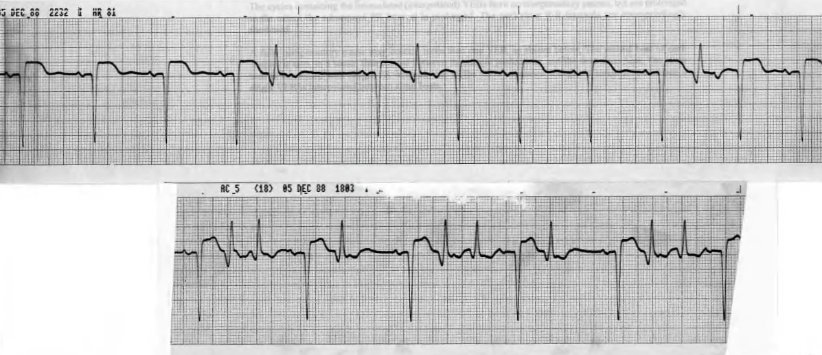 70 year old man with coronary and hypertensive heart disease .