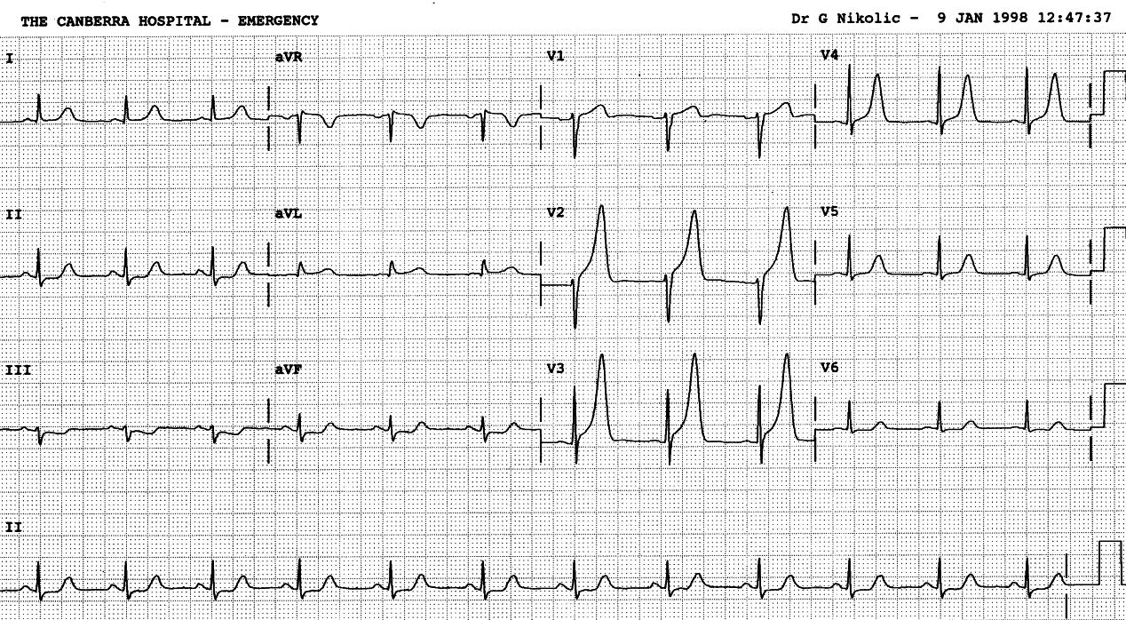 41 year old man with chest pain.