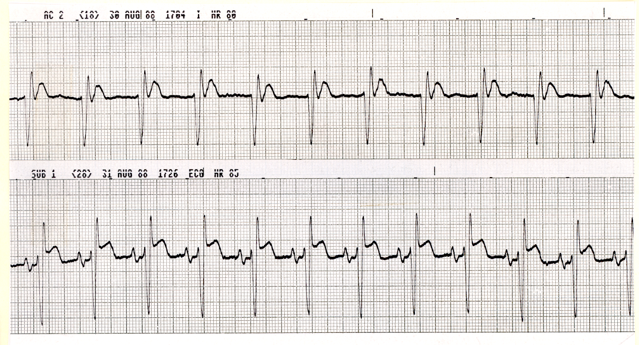 Retrograde P waves in the upper strip and short QT interval in both strips.