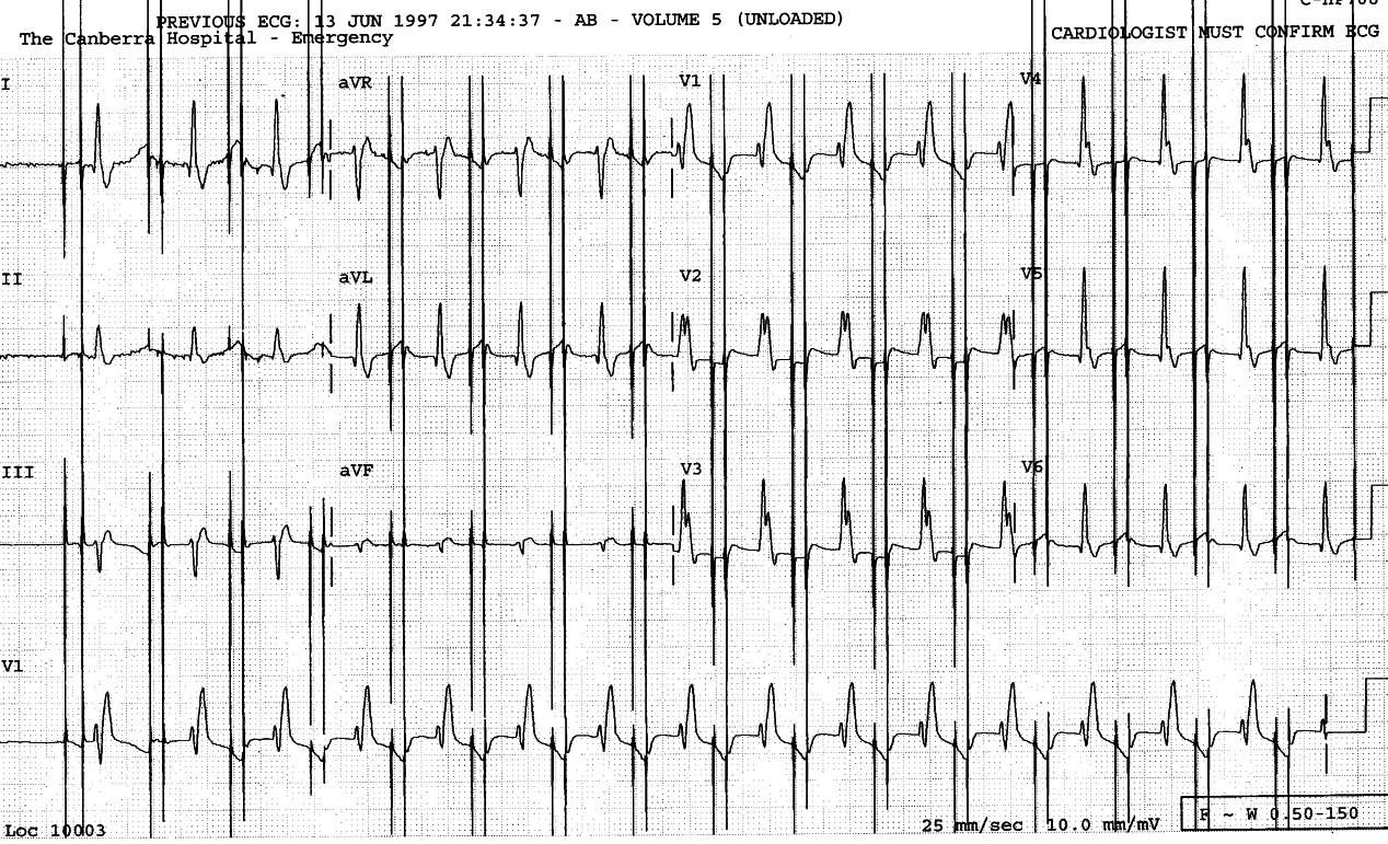 Magnet rate ECG of a 67 year old man with atypical chest pain
and history of pacemaker implant for sick sinus syndrome.