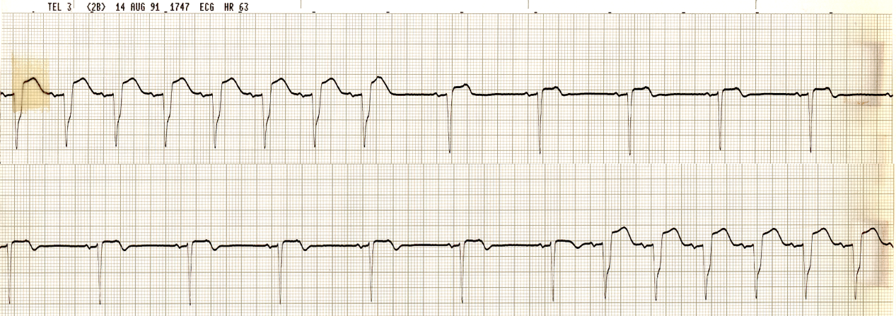 75 year old man with chronic renal failure, recently     cardioverted from atrial fibrillation. Continuous strip.  