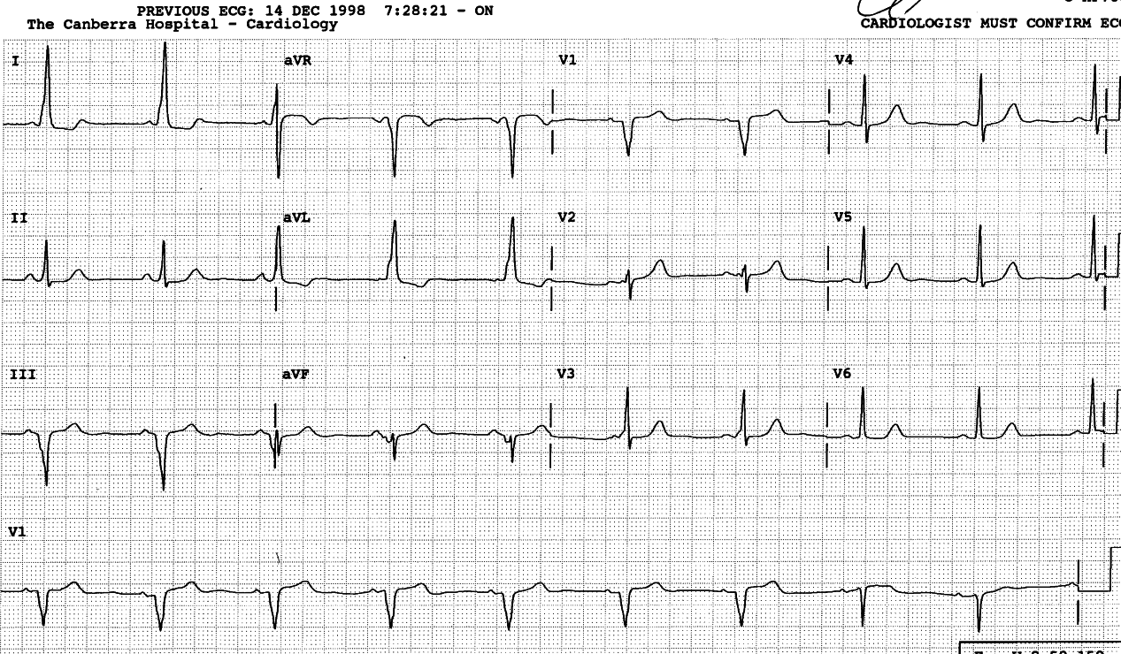 69 year old lady with chest pain.