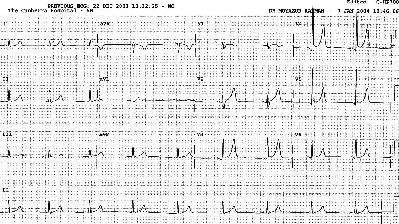 Preoperative ECG. Tall T waves are part of the early repolarisation âsyndromeâ.