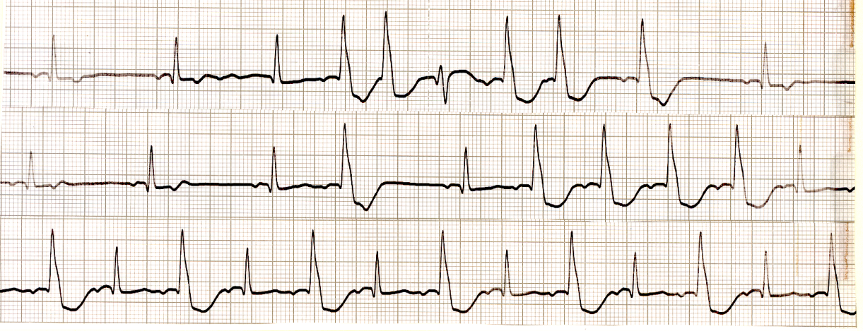 Different lead, unspecified, later. There are SVEBs and a VEB,     with alternating (known) LBBB in the bottom strip. 