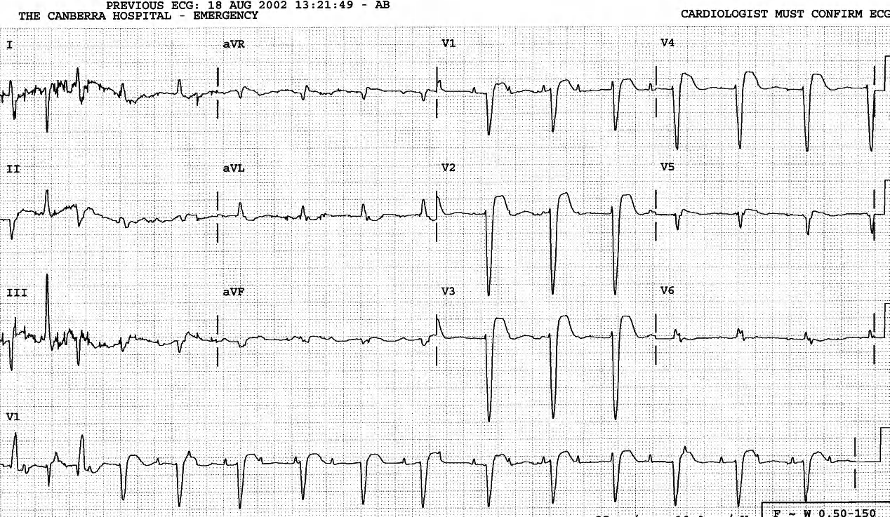 The thin second QRS is a fusion beat, with three claimants to participation: bidirectional RBBB-like VT, accelerated junctional rhythm with LBBB and the autonomous   atrial tachycardia. The last one is most unlikely, since it cannot be seen to be conducted anywhere else. 