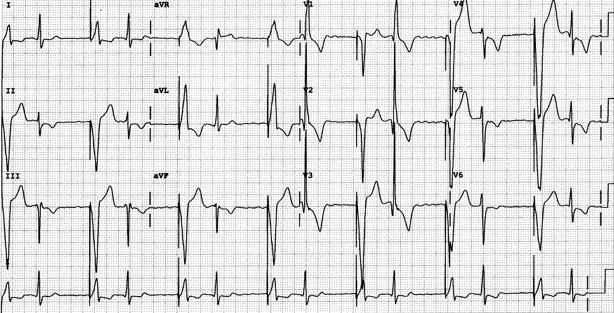 85 year old man with chronic atrial fibrillation and permanent ventricular pacemaker. 