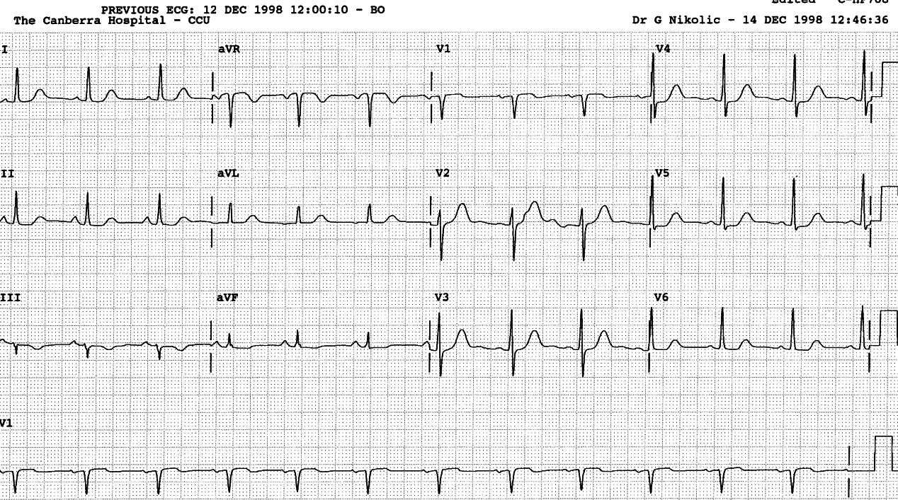 The âhorizontalâ ST segments, about 1mm depressed, suggest ischÃ¦mia, but less than in male subjects.