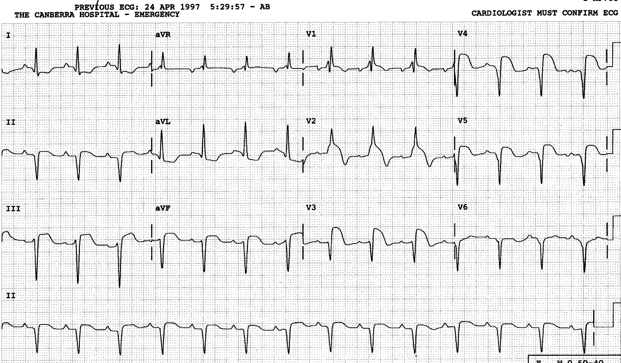 75 year old physician with chest pain. He refused surgery despite proven triple vessel disease.