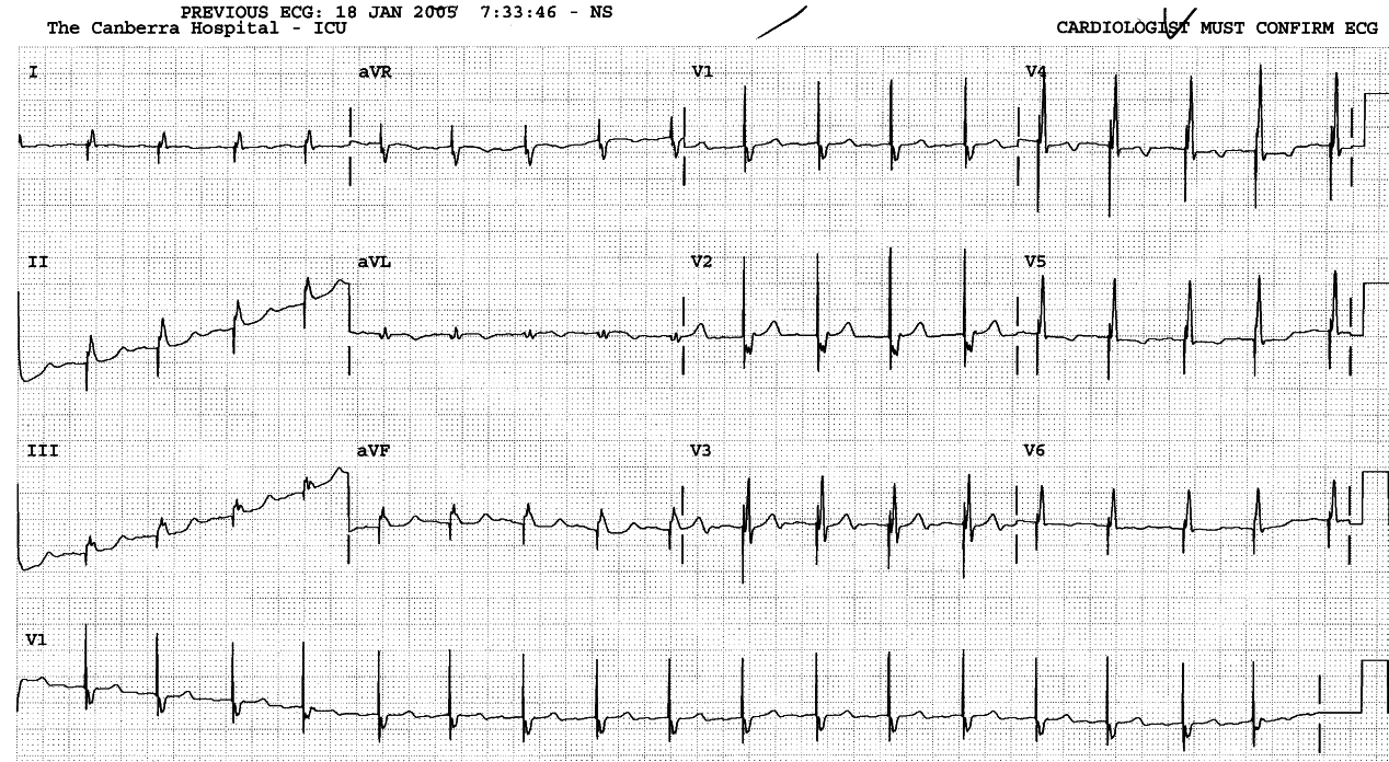 66 year old man with temporary pacemaker
post-CABGs.