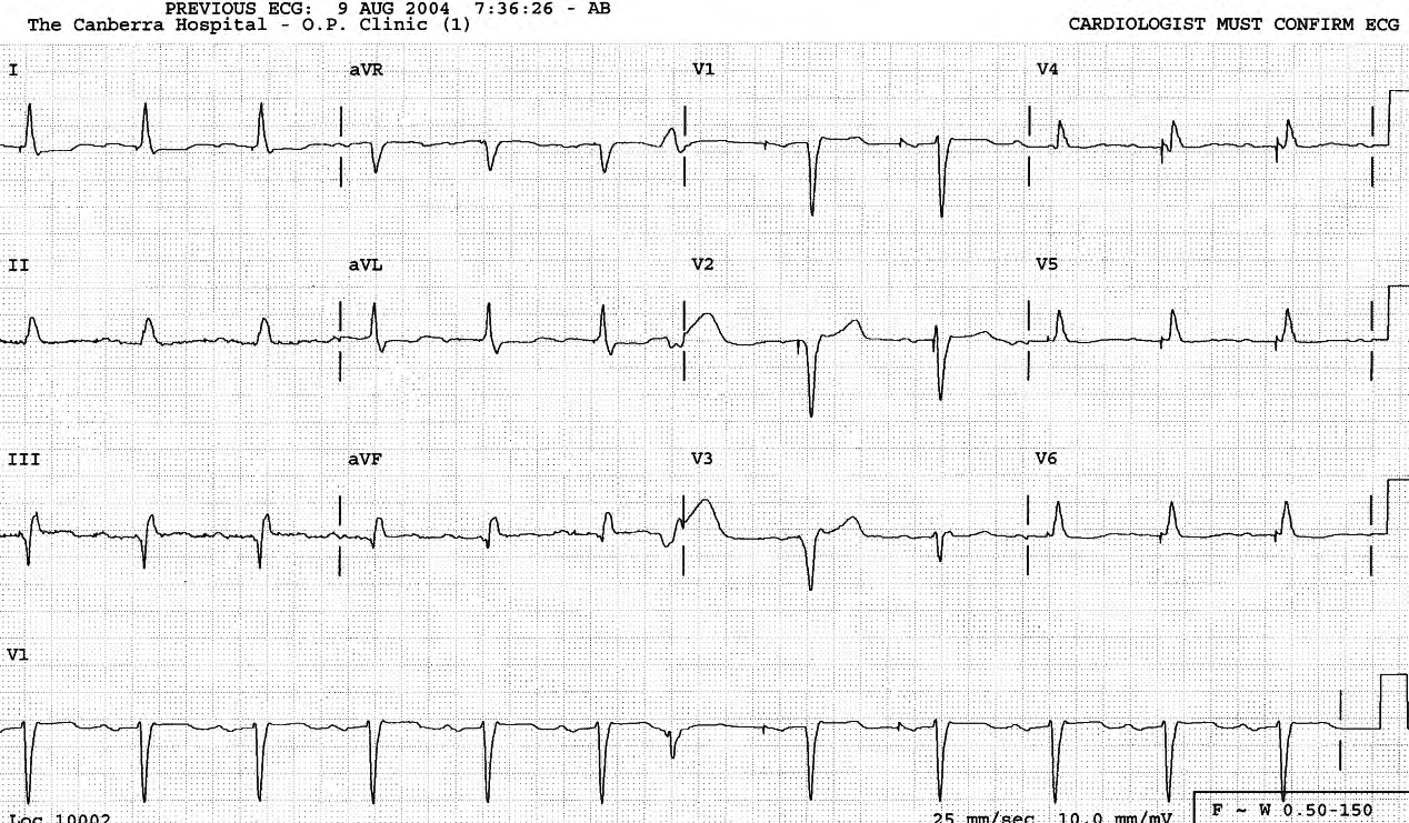 AV-paced rhythm with long AV interval promoting narrow(er) QRS complexes. Apart from the VEB, all the beats are probably fusion beats. It is also possible that theventricular lead does not work and the QRSs show the patientâs native IVCD.   