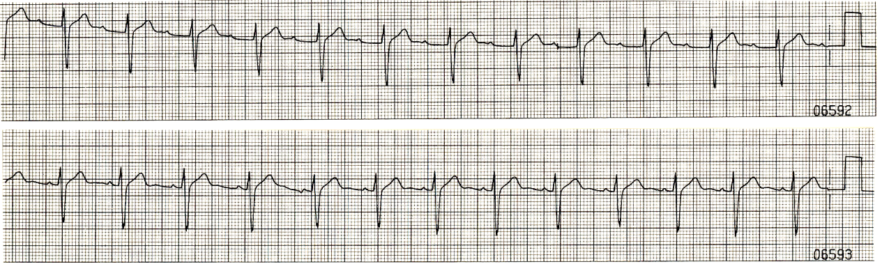 19 year old diabetic in ICU with resolving ketoacidosis. He has a history of recurrent SVT. 