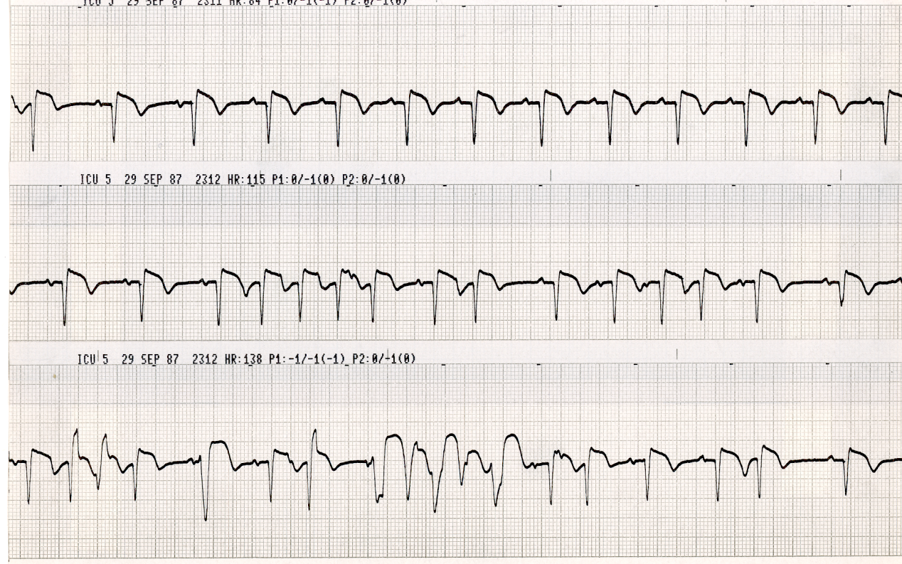 A CVC was twisted in the innominate vein. Were the attempts to straighten it successful?