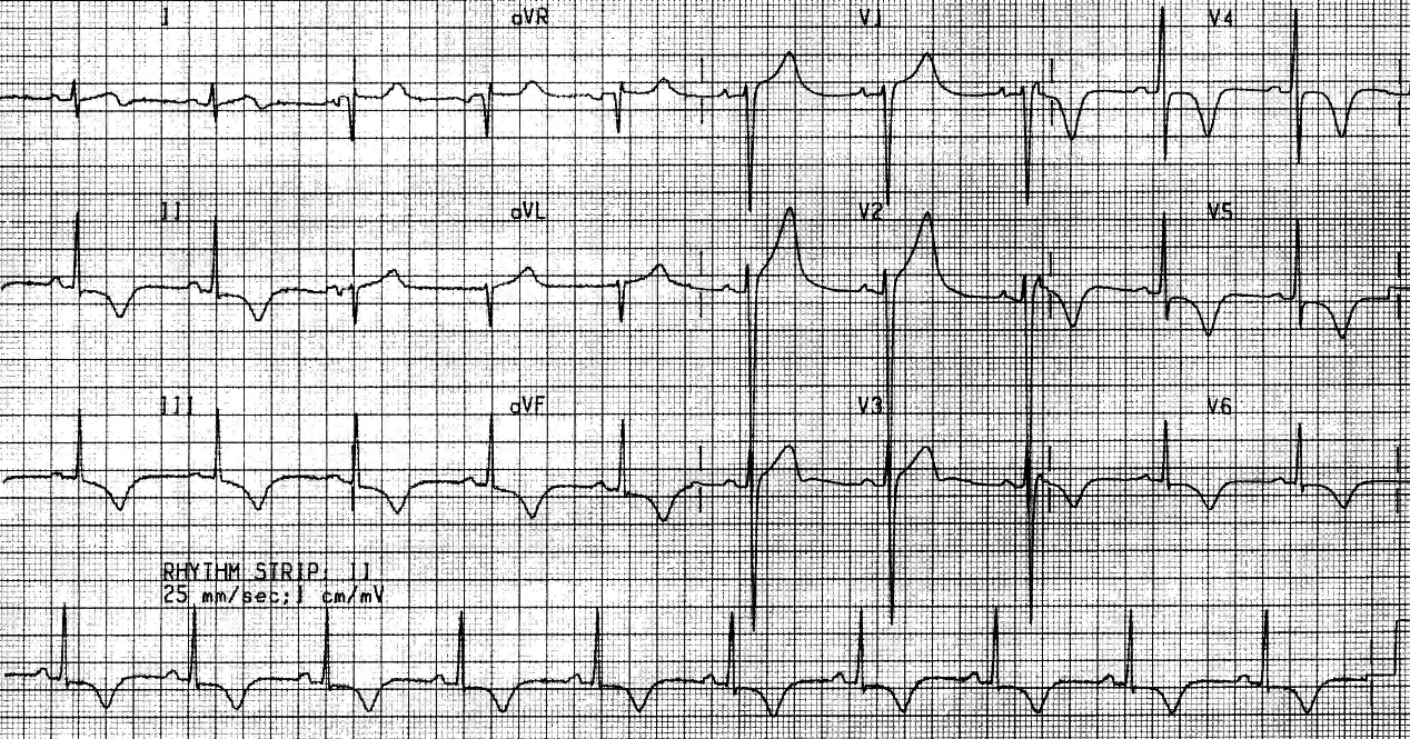 Post-tachycardia T wave inversion. 