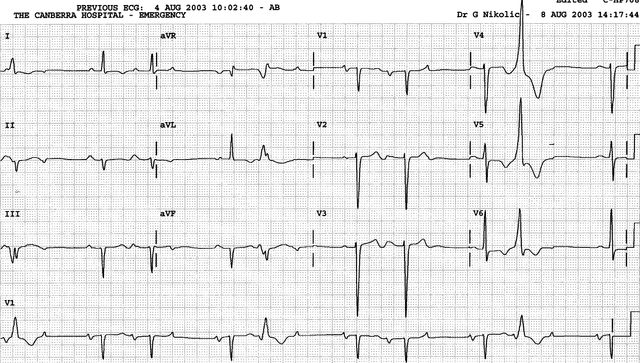 89 year old man with irregular pulse. 