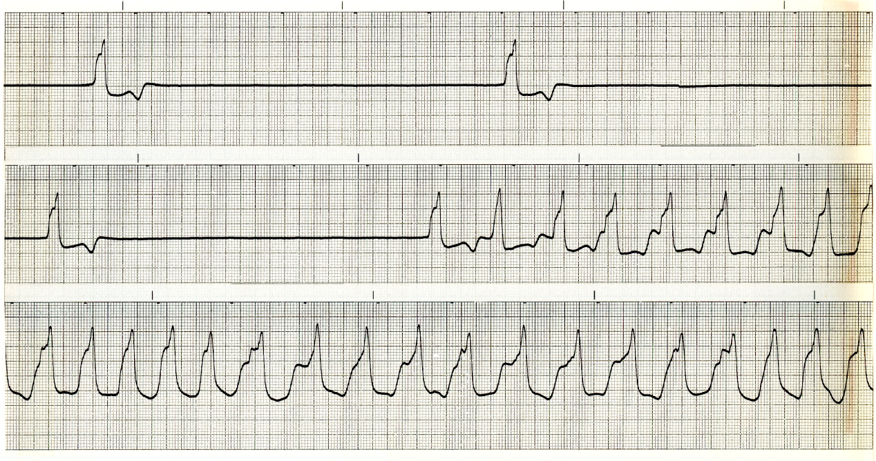 Terminal strips of a 71 year old man in multiple organ failure