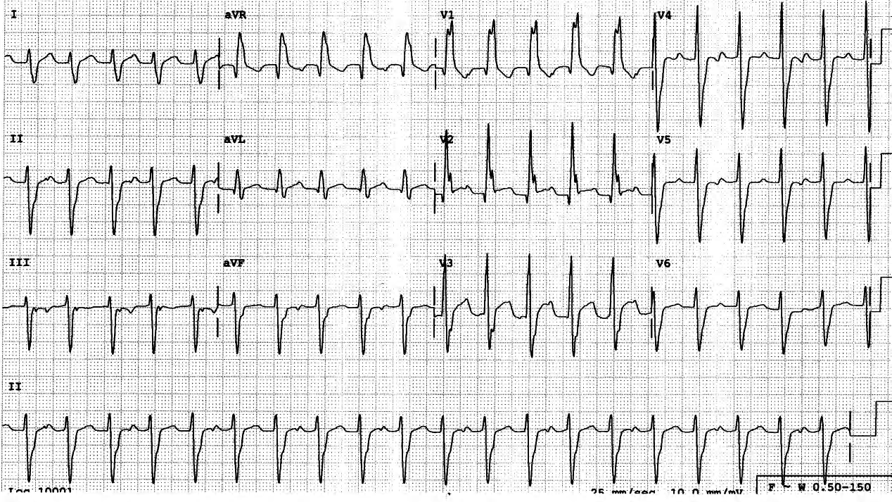 19 year old youth with recurrent palpitations. Extensive studies, including EPS, showed no structural heart disease. 