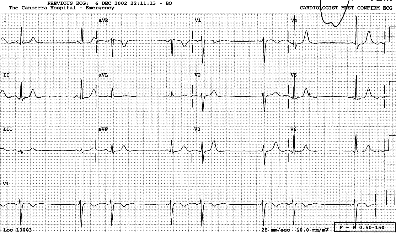 Asymptomatic 46 year old lady also noted to have bigeminal pulse. 