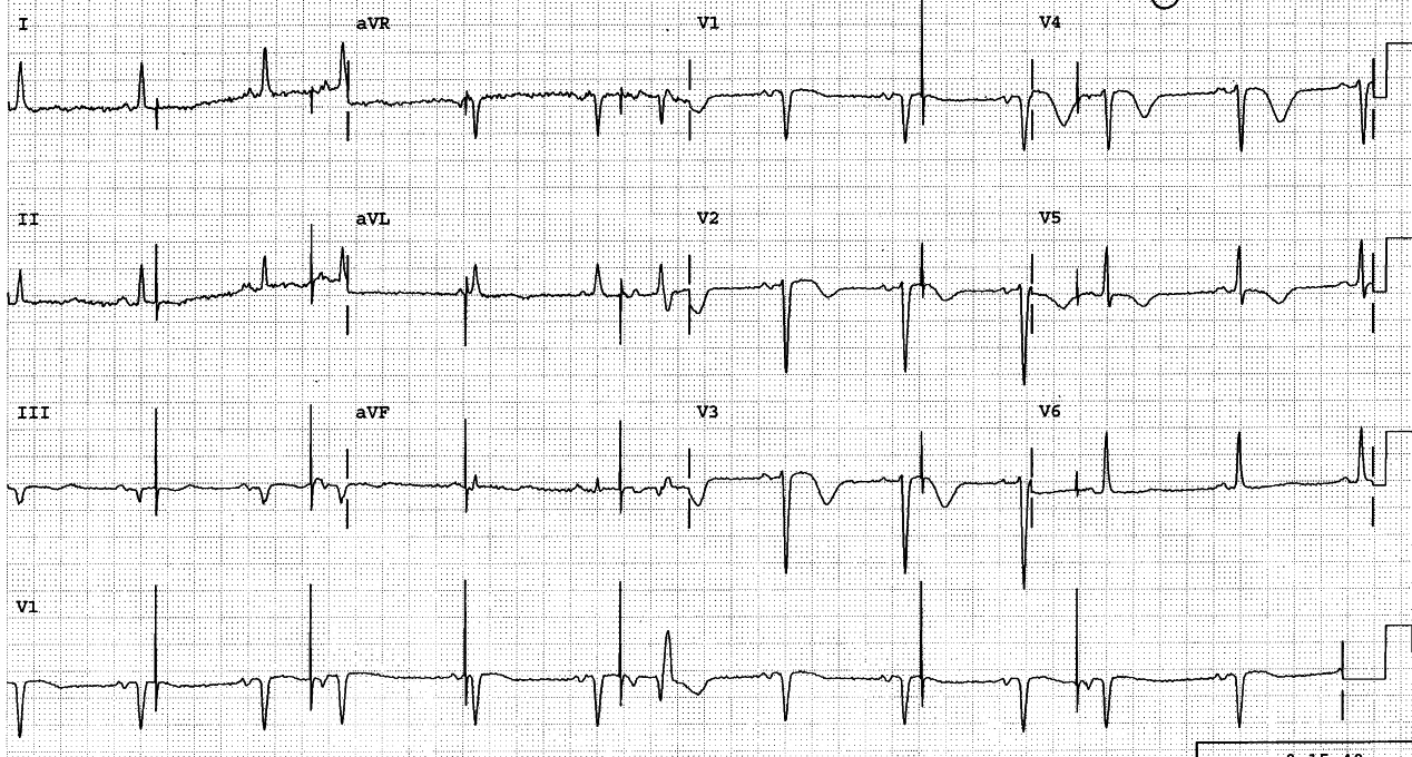 Asymptomatic 72 year old man four days after CABGs. A
temporary pacemaker is still in place.