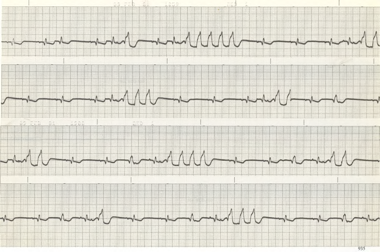 50 year old woman with history of anterior MI and atrial fibrillation. Serum digoxin level is in the therapeutic range. 